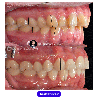 عکس قبل و بعد نمونه کار ارتودنسی دکتر حمید قاسمی