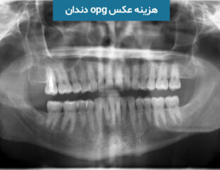 هزینه عکس opg دندان