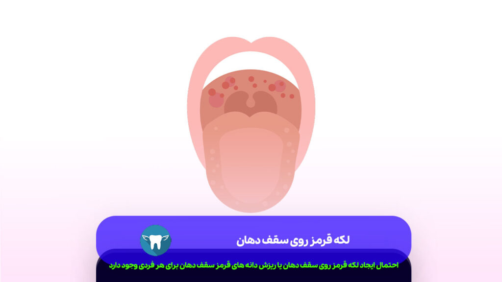 لکه قرمز روی سقف دهان