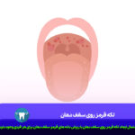 لکه قرمز روی سقف دهان