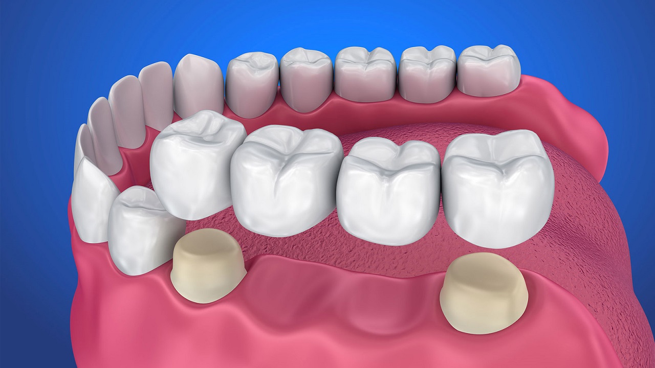 نحوه قرارگیری دندانها در پل دندان
