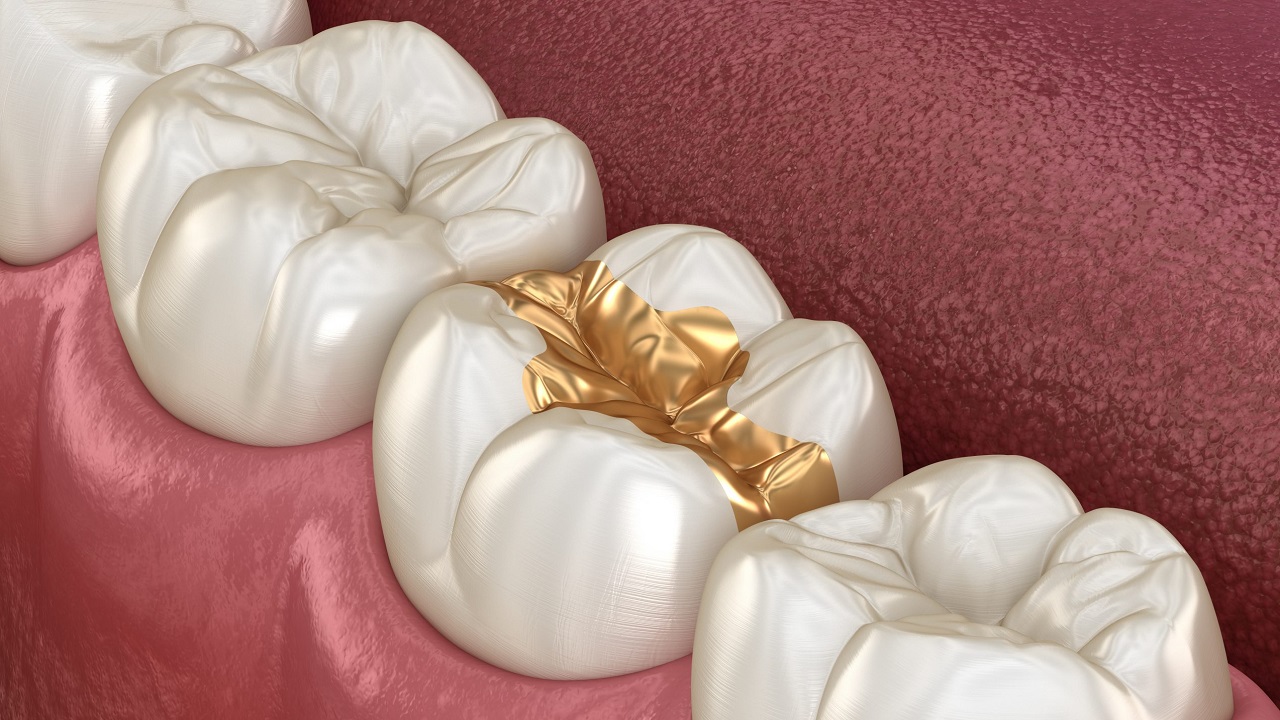 پر کردن دندان با طلا