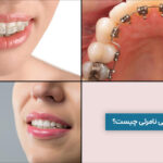 انواع ارتودنسی نامرئی