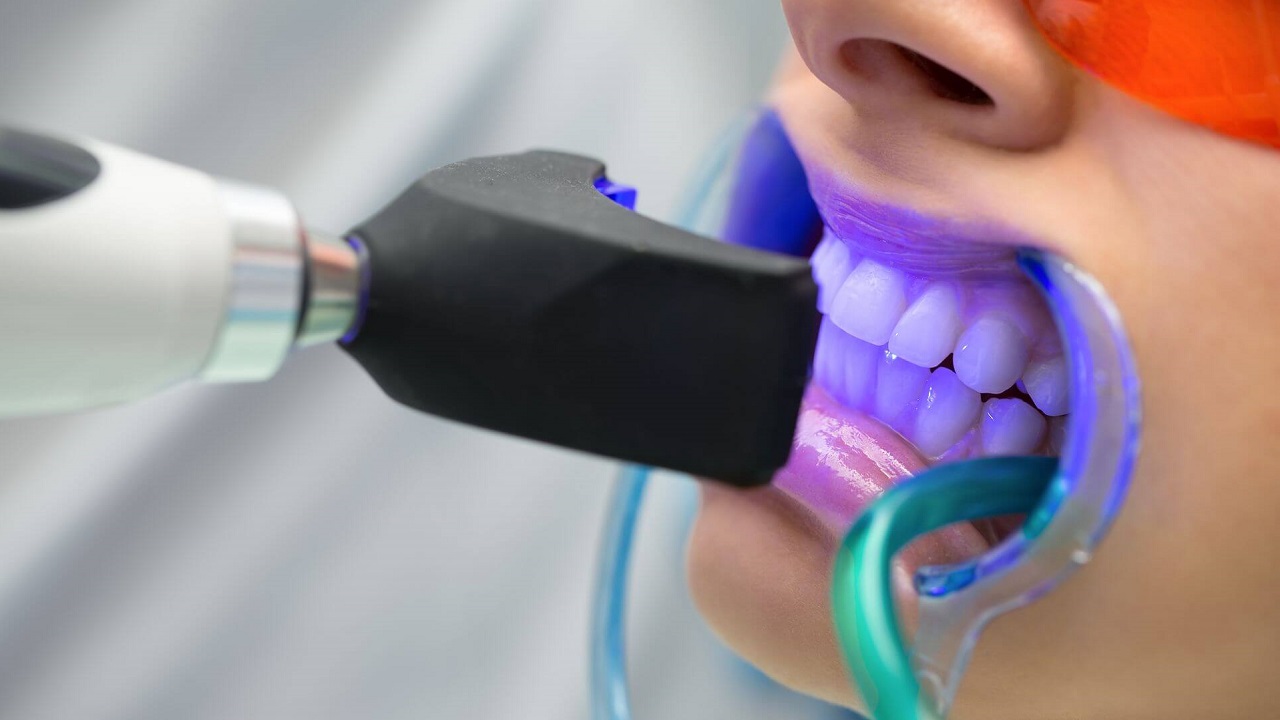بلیچینگ دندان در کلینیک