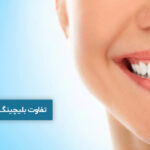 تفاوت بلیچینگ و جرمگیری دندان