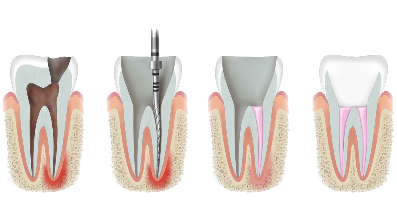 مراحل عصب کشی دندان
