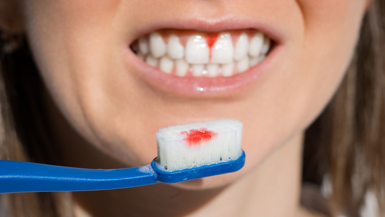 عفونت لثه از دلایل افتادن دندان