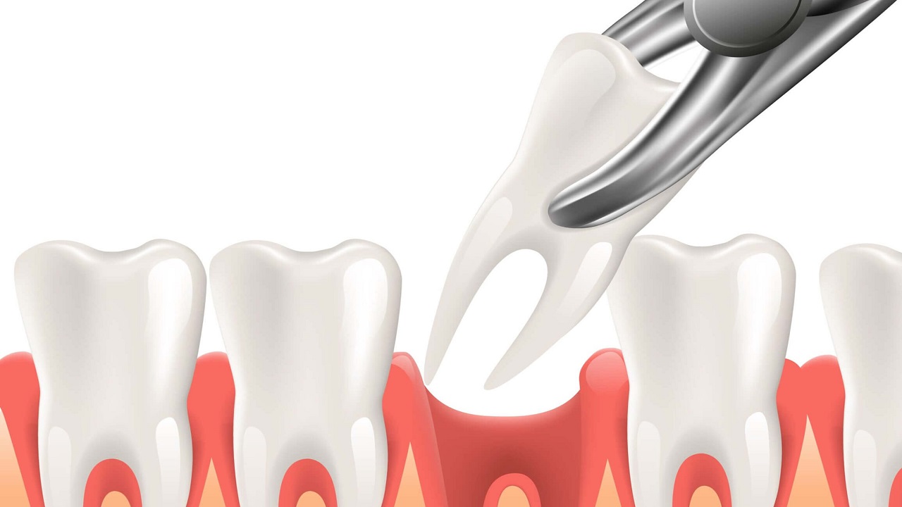 کشیدن دندان به روش ساده و معمولی