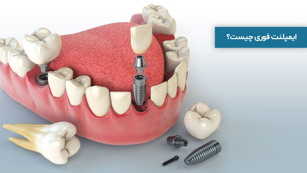 ایمپلنت فوری