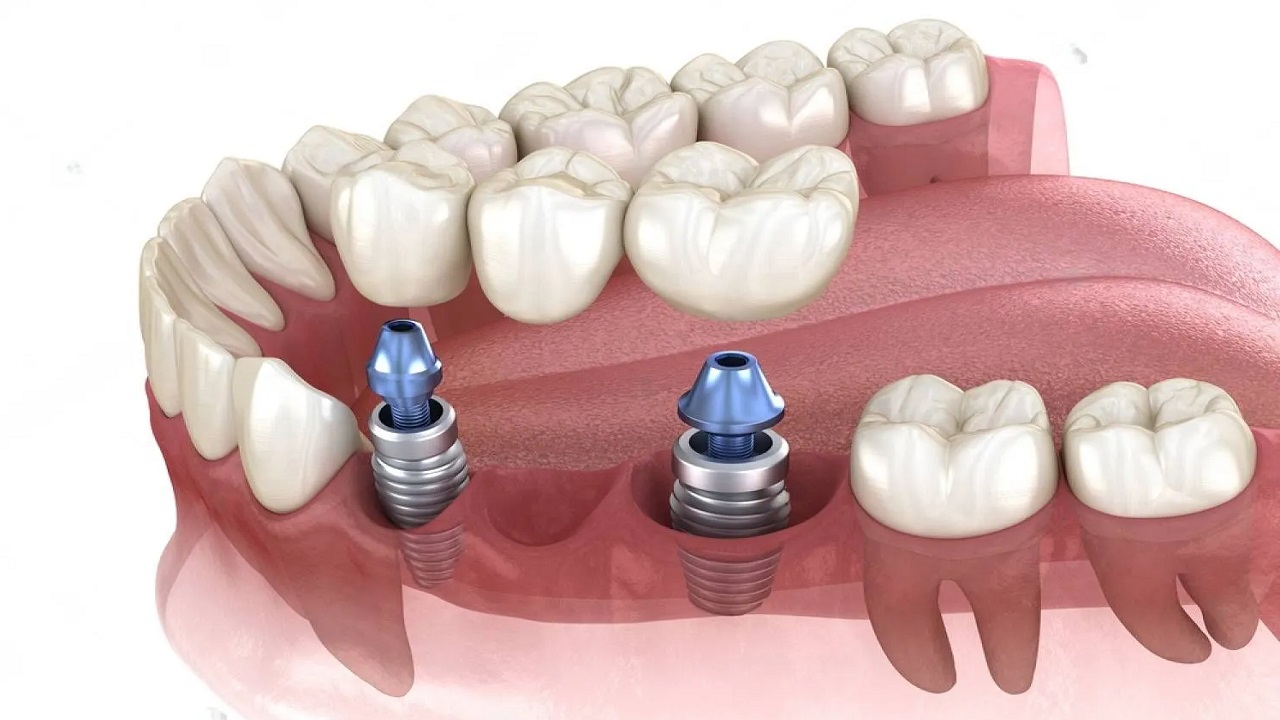 بریج دندان بر پایه ایمپلنت