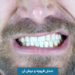 دندان قروچه