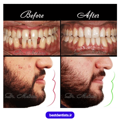 نمونه کار ارتودنسی دکتر احسان ابوئی مهریزی شماره 2