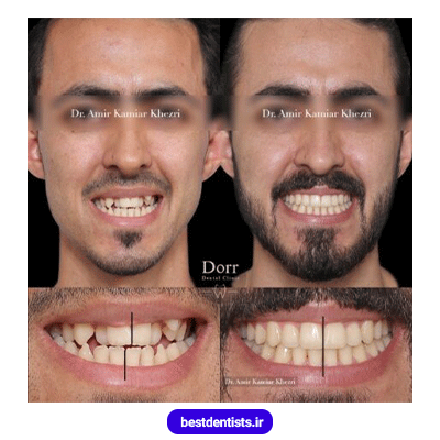 نمونه کار ارتودنسی دکتر امیر کامیار خضری شماره 1