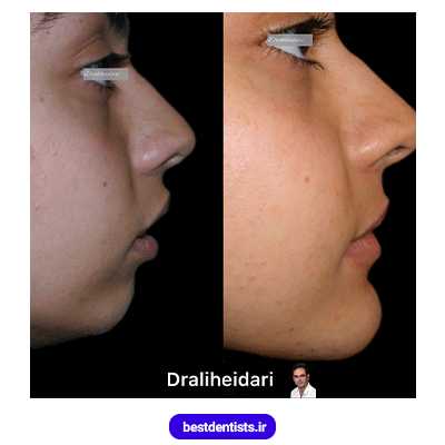 نمونه کار ارتودنسی دکتر علی حیدری شماره 1