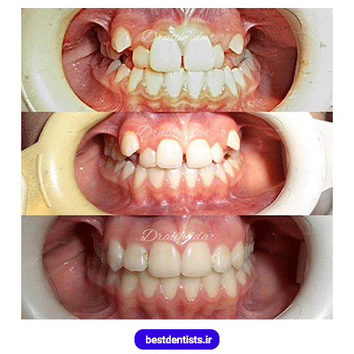 نمونه کار ارتودنسی دکتر علی حیدری شماره 2