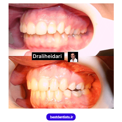 نمونه کار ارتودنسی دکتر علی حیدری