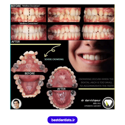 نمونه کار ارتودنسی دکتر هادی درویش پور شماره 1