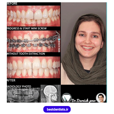 نمونه کار ارتودنسی دکتر هادی درویش پور شماره 2