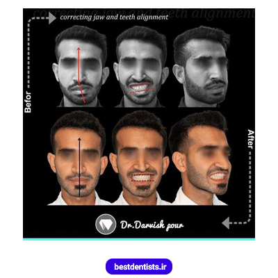 نمونه کار ارتودنسی دکتر هادی درویش پور شماره 4