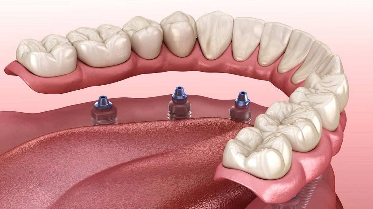 پروتز ثابت با ایمپلنت دندان