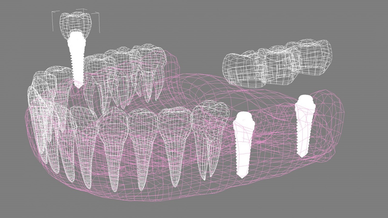 نمای دیجیتالی قرارگیری اجزای ایمپلنت بر روی دندان