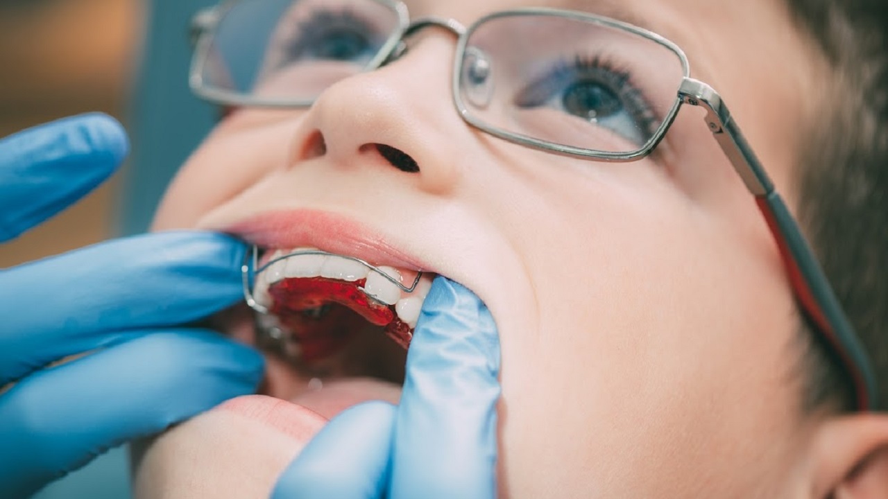 ارتودنسی متحرک در دهان کودک