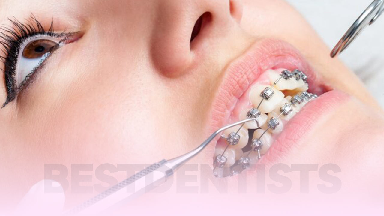 بررسی وضعیت سلامت بریس و براکت ارتودنسی ثابت