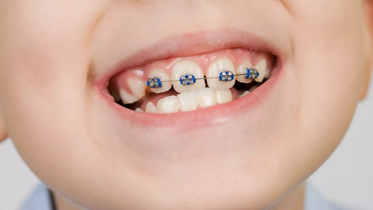 سیم کشی تعدادی از دندان های کودک