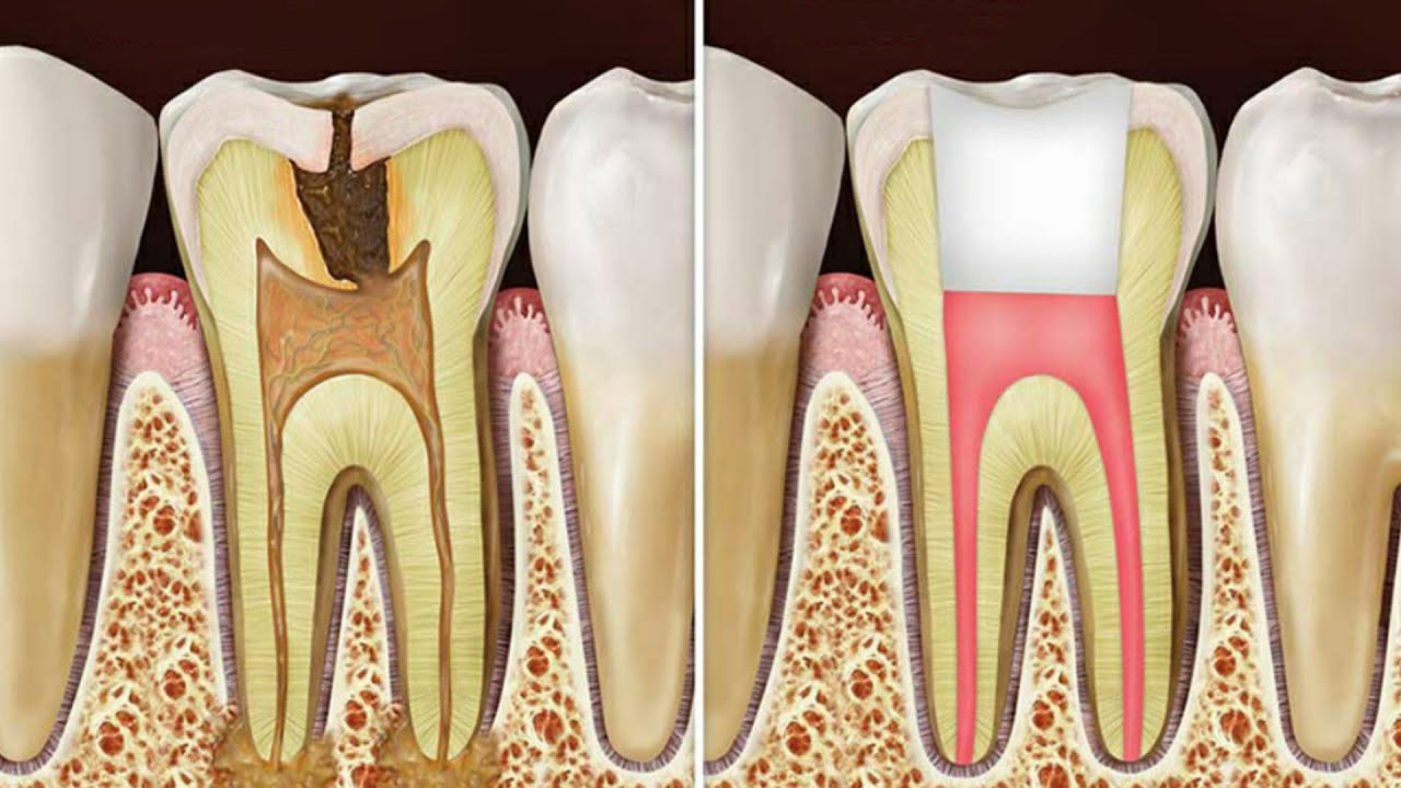 نتیجه عصب کشی دندان