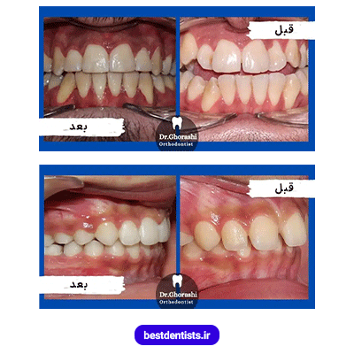 نمونه کار ارتودنسی دکتر سعید قریشی شماره 1