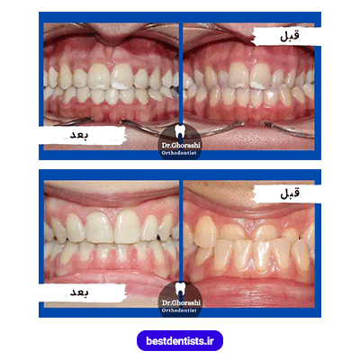 نمونه کار ارتودنسی دکتر سعید قریشی شماره 2