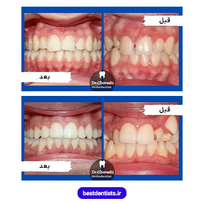 نمونه کار ارتودنسی دکتر سعید قریشی شماره 3