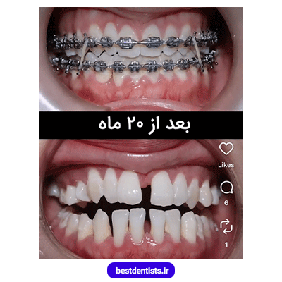 نمونه کار بعد از ارتودنسی دکتر فرهاد صدرالدینی شماره 1
