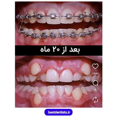 نمونه کار بعد از ارتودنسی دکتر فرهاد صدرالدینی شماره 1