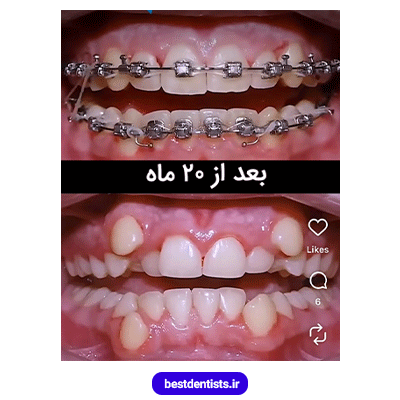 نمونه کار بعد از ارتودنسی دکتر فرهاد صدرالدینی