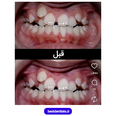 نمونه کار قبل ارتودنسی دکتر فرهاد صدرالدینی شماره 2