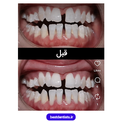 نمونه کار قبل از ارتودنسی دکتر فرهاد صدرالدینی شماره 1