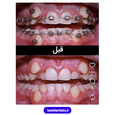 نمونه کار قبل از ارتودنسی دکتر فرهاد صدرالدینی