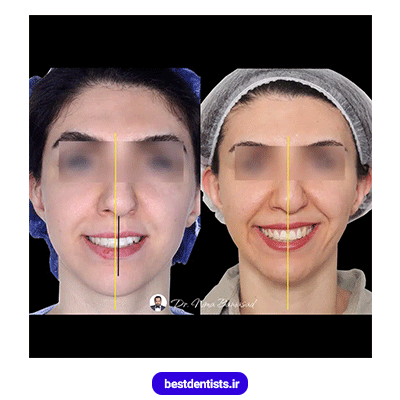 نمونه کار قبل و بعد ارتودنسی دکتر نیما بنی اسد شماره 1