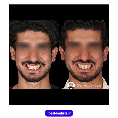 نمونه کار قبل و بعد ارتودنسی دکتر نیما بنی اسد شماره 2