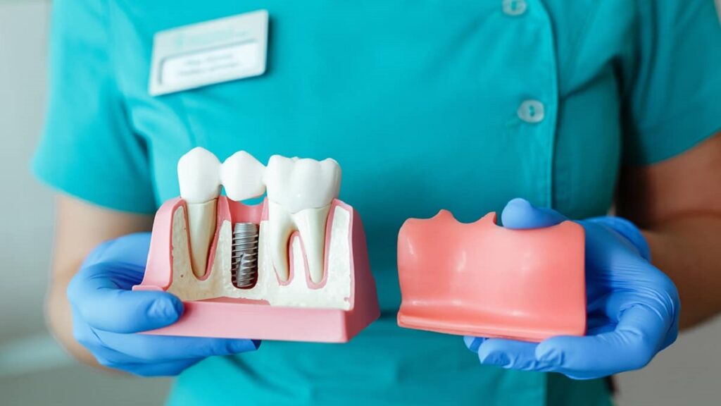 تعرفه های دندانپزشکی-ایمپلنت دندان