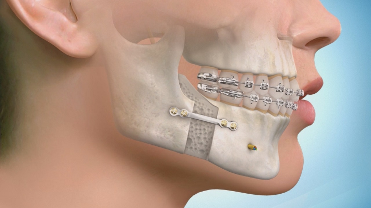 جلو بردن فک پایین طی جراحی فک