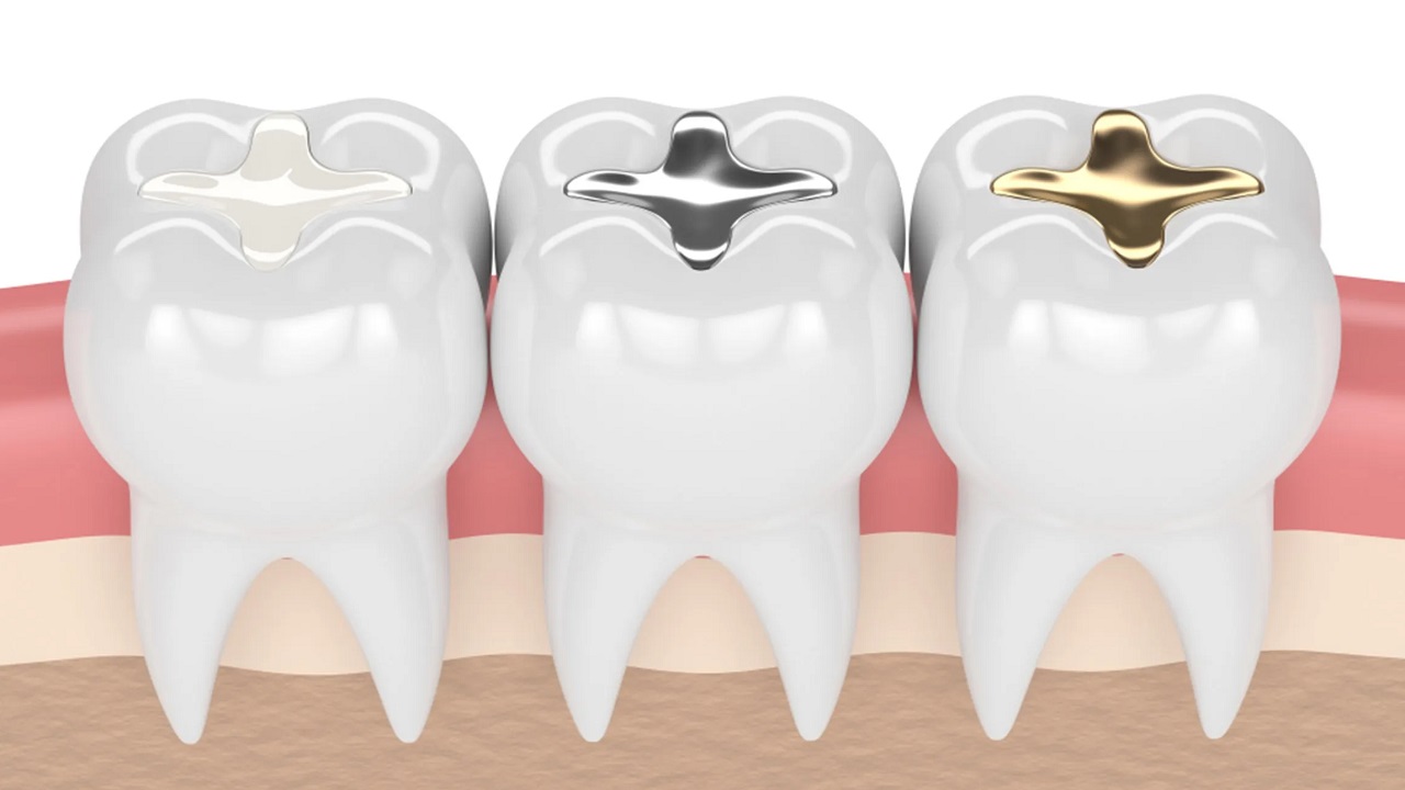 مواد پرکننده دندان