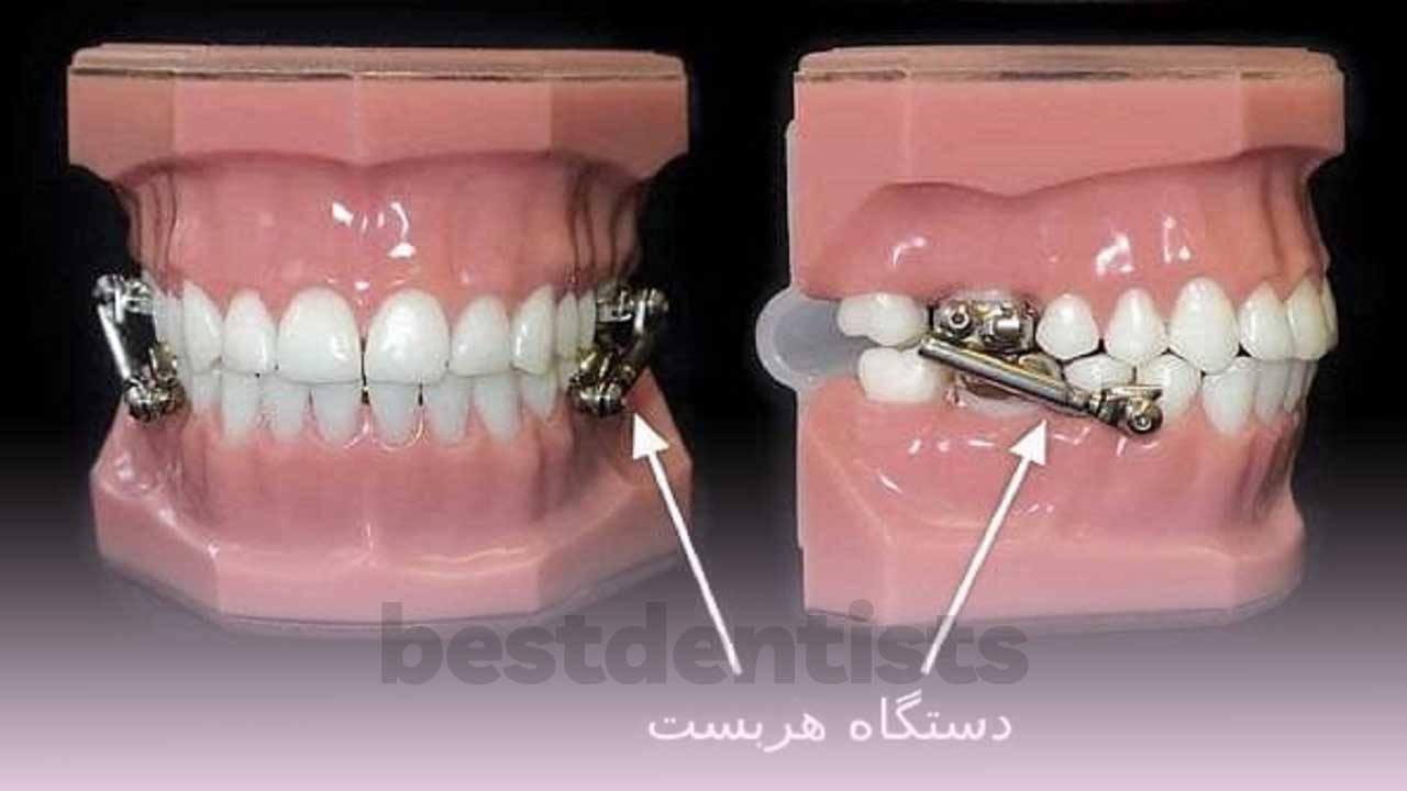 ابزار هربست سومین روش خانگی برای صاف کردن دندان