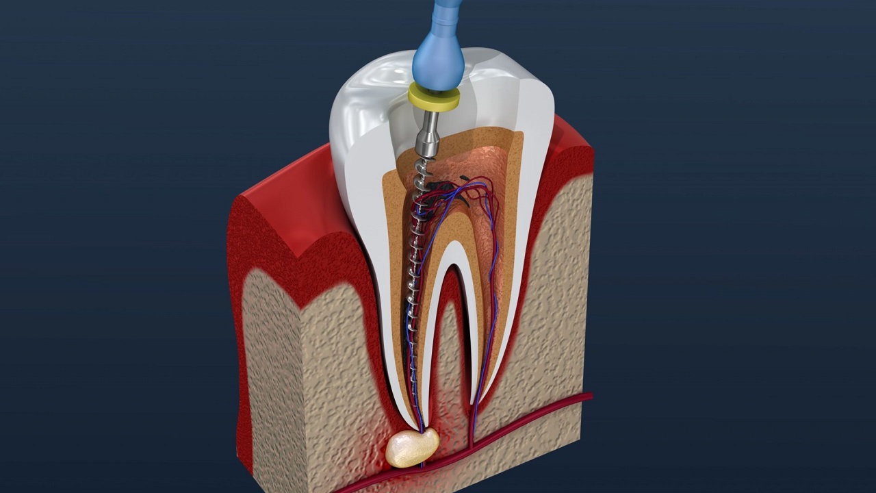 روت کانال دندان