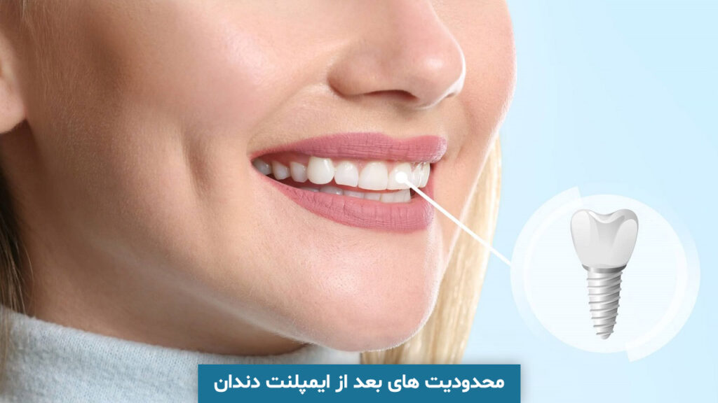 محدودیت های بعد از ایمپلنت دندان