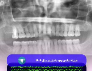 هزینه عکس opg دندان