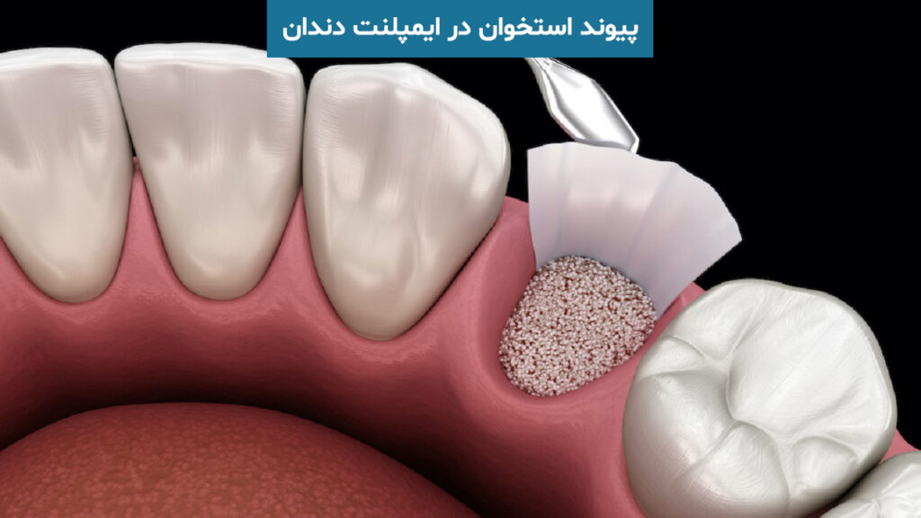 پیوند استخوان در ایمپلنت دندان