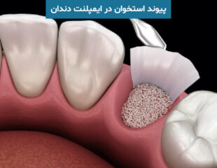 پیوند استخوان در ایمپلنت دندان