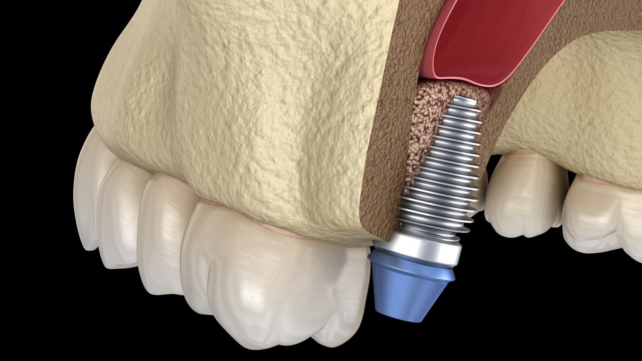 پیوند استخوان در حین ایمپلنت